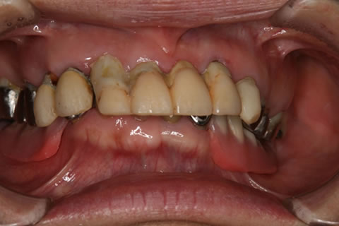審美歯科：初診時　人前で口を開けられるように、硬いものを少しでも噛めるように、総入れ歯になる前になんとかしたい。