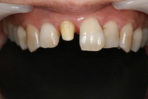 前歯部補綴症例：上顎の前歯にセラミックの冠をかぶせます。これはかぶせる前の状態です。