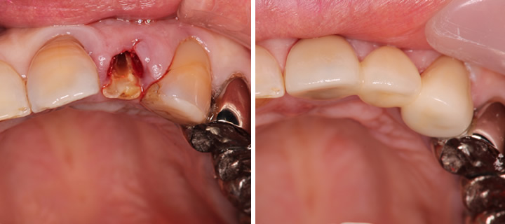 抜歯をセラミッククラウン（かぶせ物）のブリッジで補った症例